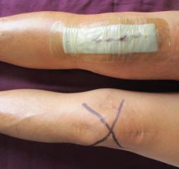 Right Knee Total Joint Replacement Surgery - 25AUG19