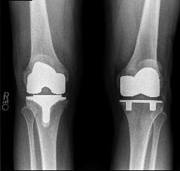 Right Knee Total Joint Replacement - 26AUG19